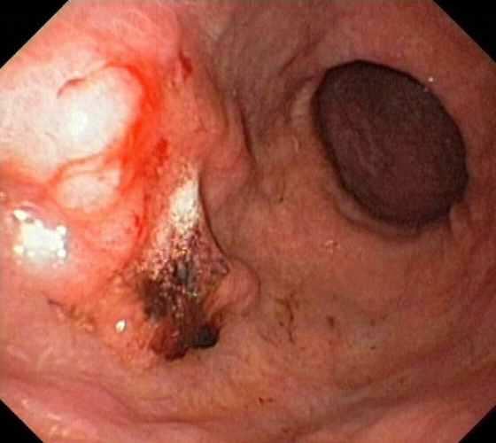Gastritis elsősorban az antrum területén