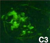 Sjögrensyndroma Sclerosis