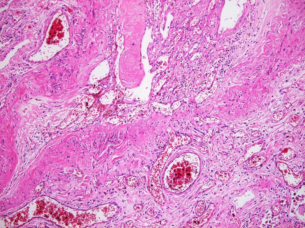 Embolus és infarctus sorsa: Felszívódik Falhoz