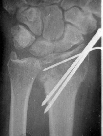 Szögletstabil lemezes osteosynthesis (palmaris LCP lemez, VCP) 7.