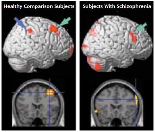 Hypofrontalitás? Kim et al. (2003): Hypofrontalitás gyenge teljesítmény, vagy épp fordítva? Más (pl.