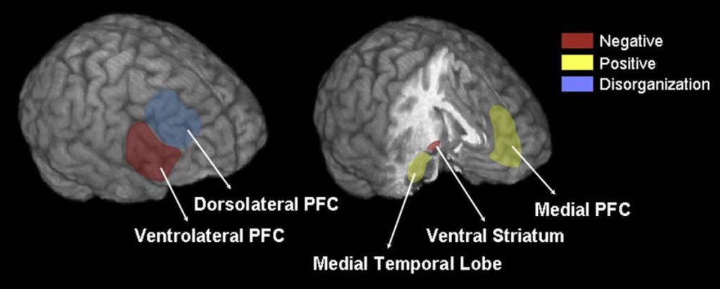 A pszichózis tünetei és az agyi aktiváció összefüggései neuropszichológiai tesztek alatt 25 funkcionális képalkotó