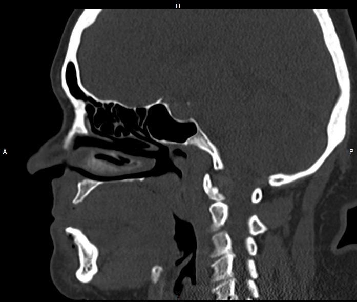 Liquorfistula okai