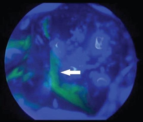 Intrathecalis fluoreszcein