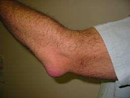 BURSITIS OLECRANI STUDENT ELBOW A