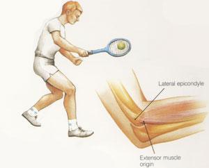 SPORTSÉRÜLÉS