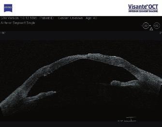 cornea esetén is. A műszer a nagy felbontású corneafelvételek segítségével alkalmas a sebvonal, a sebszélek és sebdehiscentiák elemzésére.