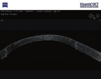 Keratoprotesis beültetése utáni állapotok vizsgálata és követése A Visante OCT alkalmas a keratoprotesis implantációját követően annak pontos helyzetét, majd időbeni