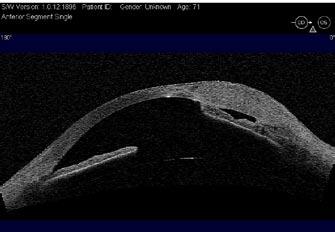 Sclerokeratoplasztika után látható a széli részeken megvastagodott transzplantátum és az anterior synechia tos tervezéséhez, valamint a glaucoma diagnózisában és értékelésében.