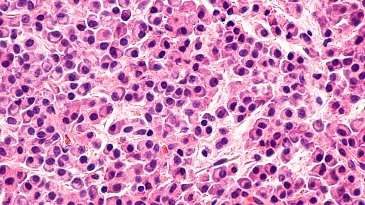 Myeloma multiplex: a második leggyakoribb haematológiai malignoma Évente 400