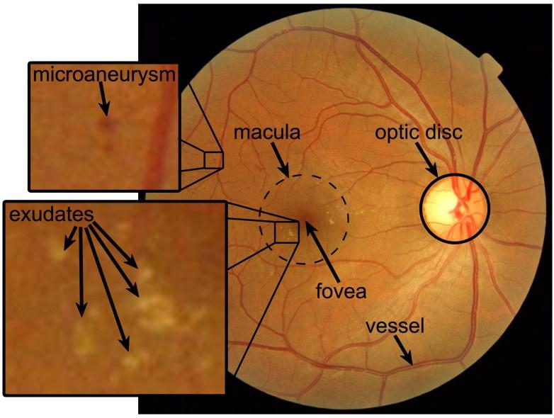 Figure 2: Anatomical parts of the retina with signs of DR.