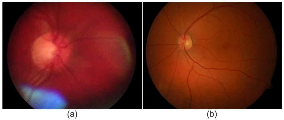 The value of and in case of mostly depends on the resolution of the applied CCD sensor in the fundus camera.