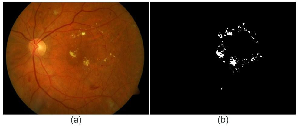 Figure 8: Manual annotation containing precise exudate regions; (a) RGB fundus image, (b) manual drawn binary mask. 2.1.