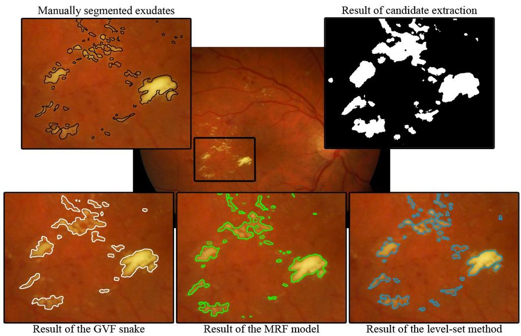 Figure 27: Results of the three different ACMs initialized by (i=1,2,, ). To segment the contours of exudates more precisely, we propose the following ensemble of the image enhancement methods.