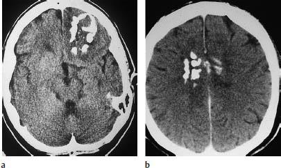 2.2. Az oligodendroglioma Az oligodendroglioma a fehérállományban található oligodendroglia sejtekből alakul ki, melyek a myelinhüvely képzésében és alkotásában vesznek részt.