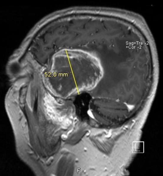 A beteget megműtötték. A kiműtött daganatsejtek szövettani eredménye Oligodendroglioma WHO Gr. II. t igazolt. 1p/19q státusz FISH vizsgálattal negatív lett.