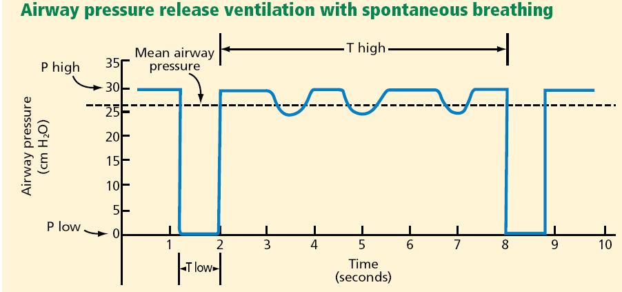 APRV lélegeztetés karakterisztikája Frawley