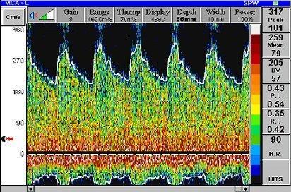 Transcranialis Doppler (TCD) A TCD az erekben áramló vér sebességét méri A véráramlás változás arányos az áramlási