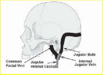 Bulbus juguli oximetria (SjvO 2 ) V.