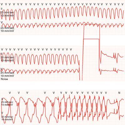 ICD Shock