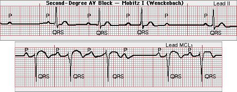 Ritmuszavar - brady CM indokolt: I-II (Mobitz I) AVB, syncope az anamnesisben sinus