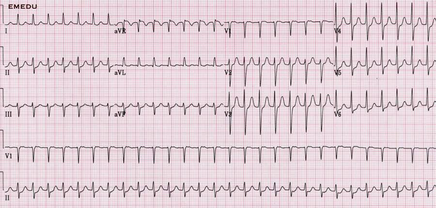 adenosin 6 12 12 mg iv (WPW?