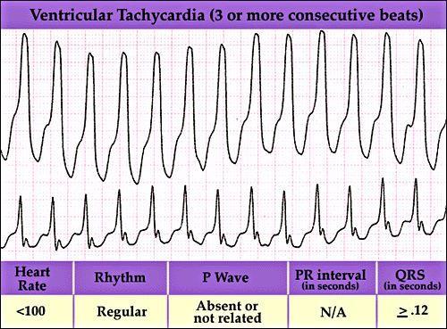 Tachyarrhythmia Stabil beteg -