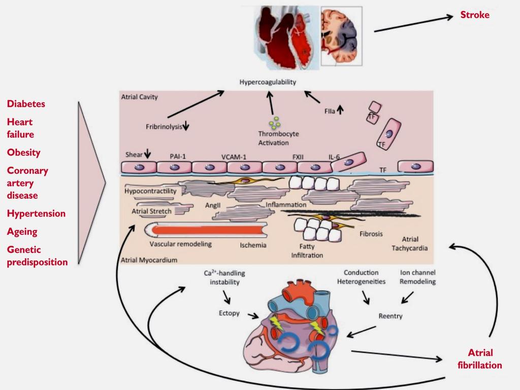 Pitvarfibrilláció (AFib) From: 2016 ESC Guidelines for the management of atrial fibrillation