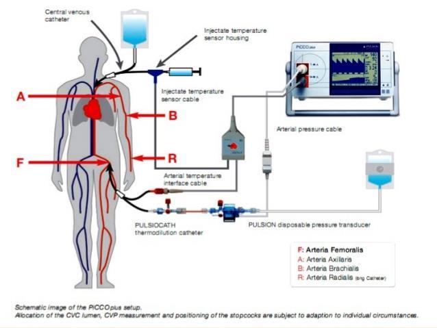 Invazív hemodinamikai monitorozás PiCCO