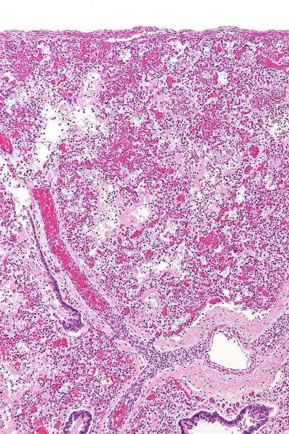 Alveoláris barriert alkotó sejtek diffúz sérülése jellemzi : surfactans dysfunkció veleszületett immun válasz