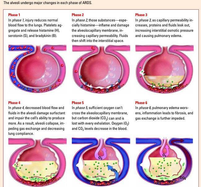 Csökkent véráramlás tct aggregátumok, hisztamin, bradykinin Kapilláris permeábilitás fokozódik, folyadék shift alakul ki az intersticiális tér felé Protein dús folyadék lép ki, intersticiális