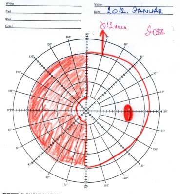 Neuroophthalmologiai status JAN 2012 ( 3 héttel a VP shunt műtét után)