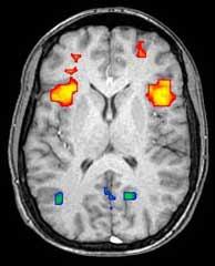 Funkcionális mágneses rezonancia képalkotás (functional Magnetic Resonance Imaging) Az MRI