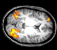 véráram vénás [deoxihb] Blood Oxygen Level Dependence (BOLD) fmri aktiváció Flickering