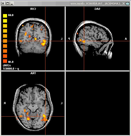 SPM=Statistical Parametric Mapping Brain Voyager