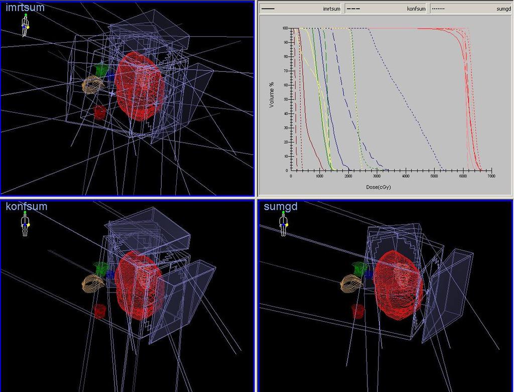 Plan Structure Volume (ccm) Mean Dose cgy Mean Dose cgy Mean Dose cgy Average Dose cgy Anyag-módszer Age Gender Primer tumor localization Hystology Dose MR controll* Tartalmi oldalak alapja Patient 1