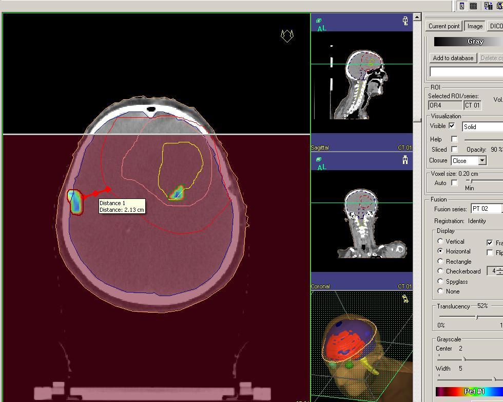 Tolerálhatóság- önkéntes vizsgálatok Azonosító Nem Életkor Az első vizsgálat dátuma Kezesség [érték] fmri002 22 2011.10.02 jobb 1. Nő (+100) 2. fmri004 Nő 23 2011.09.11 jobb (+80) 3.