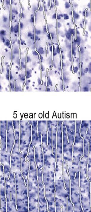 Neuronális eltérések autizmusban Nagyobb agyméret - korai