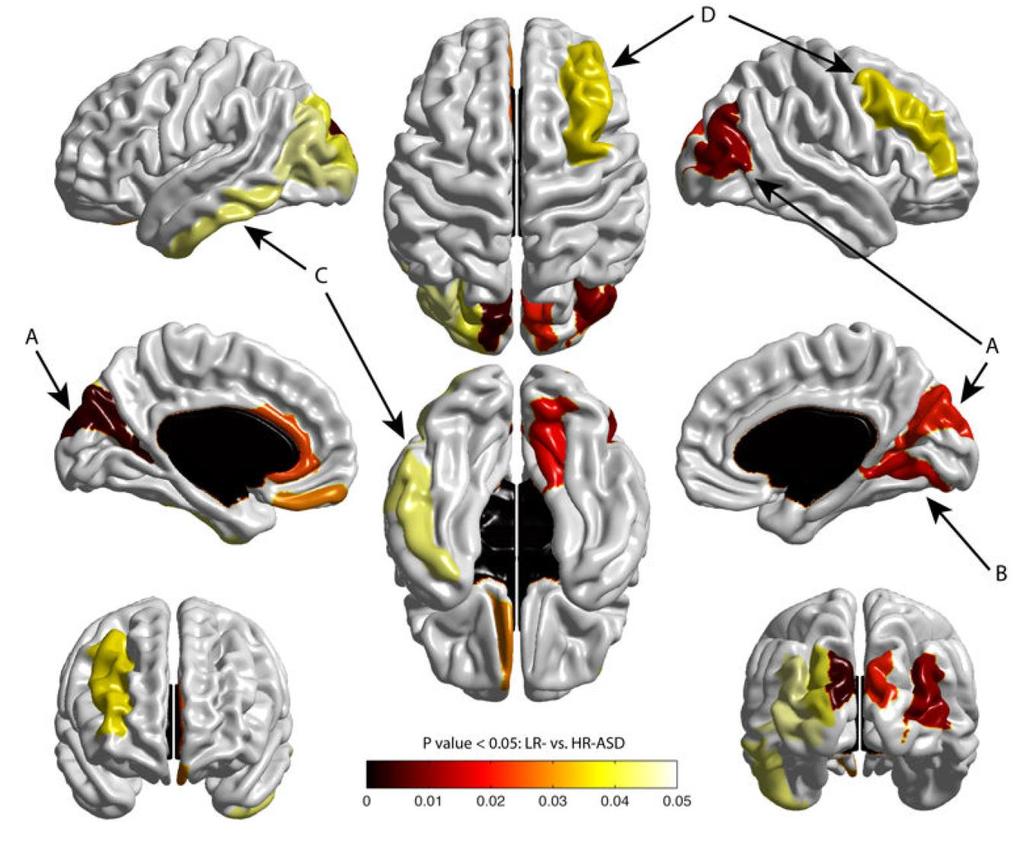 Autizmus szempontjából magas kockázatú gyermekek fokozott agyi felszínexpanziója (6-12 hónapos életkor) A: gyrus occipitalis