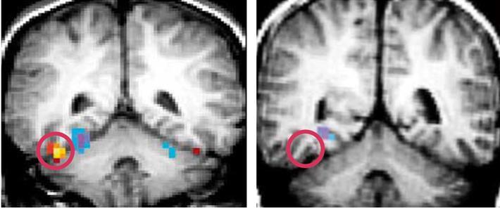 ToM hálózat: default hálózat - szociális jelzésdetekció nyelvi-szemantikus funkciók - medialis PFC - sulcus temporalis superior (STS):