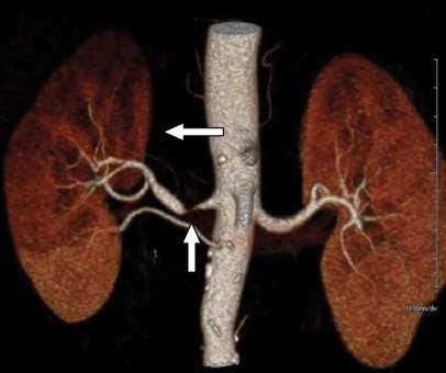 Renovascularis hypertonia Jelentősége: súlyos hypertonia (diast:110-130 Hgmm) hypertonias betegek 2-5%-a egyoldali stenosis esetén is hypertonia (renin-angiotensin rendszer aktivált) kezelésével