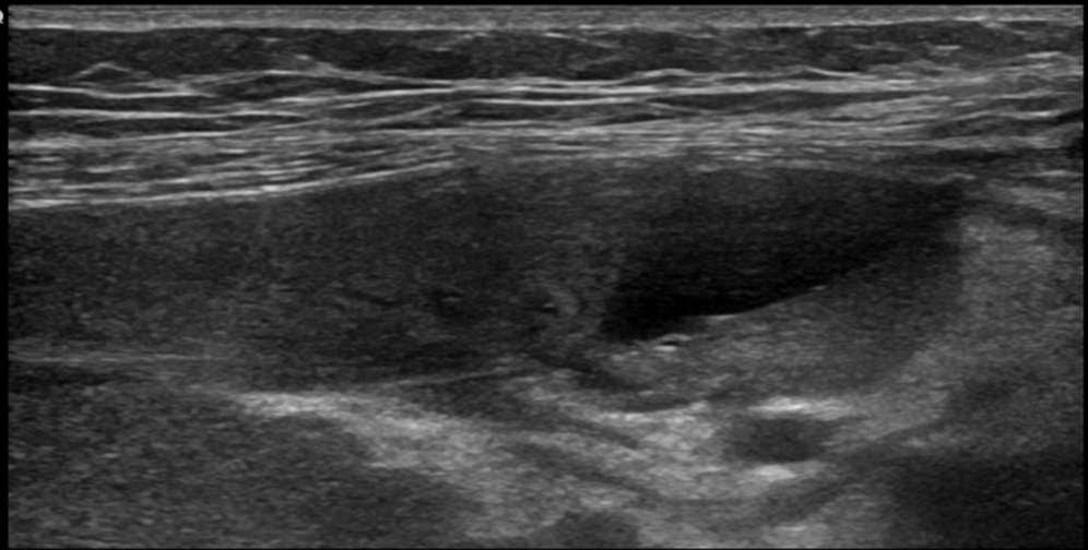 Keringési zavarok Veseinfarctus: a veseállomány részleges v.