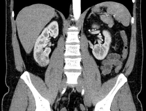 Rosszindulatú daganatok Hypernephroma (vesesejtes rák, Grawitz tumor) többségében sokáig tünetmentes, haematuria kivizsgálás