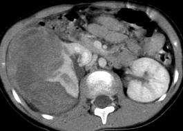 Nephroblastoma (embrionalis adenomyosarcoma, Wilms tumor) kialakulás embrionalis korban, korai gyermekkorban kifejlődés, felfedezés, mint tapintható hasi