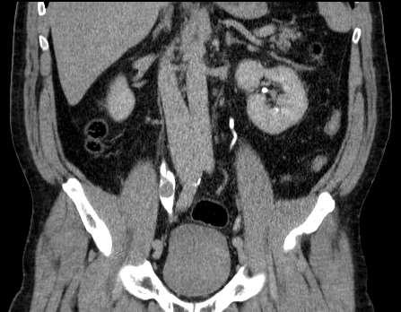 Ureter haematuria, fájdalom, anuria Vizsgáló módszerek UH: korlátozott, csak felső harmad CT- urographia: kielégítő ábrázolás MR urographia: jó ábrázolás Kiválasztásos urographia Retrograd