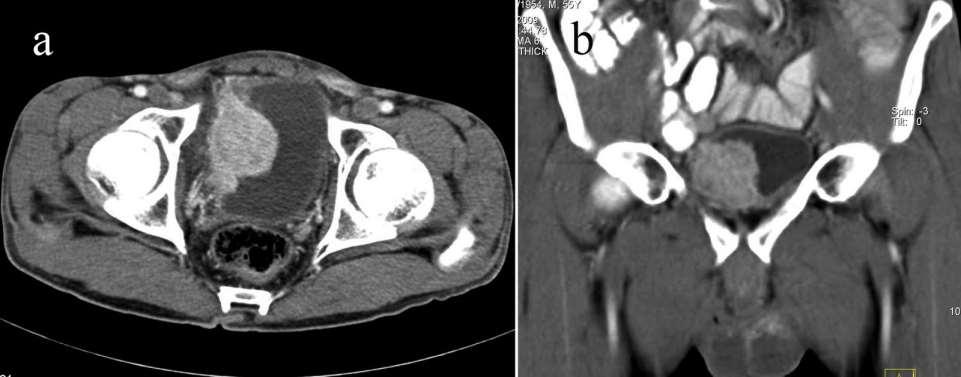 Húgyhólyag haematuria, dysuria, pyuria, bacteriuria Vizsgálómódszerek UH: telt hólyag mellett jó ábrázolhatóság, de nem kizáró értékű kő, nyálkahártya megvastagodás, intracysticus növedék, sűrű