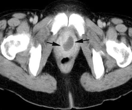 Urethra dysuria, haematuria, bacteriuria Vizsgálómódszer: Mictios urethrocystographia nők