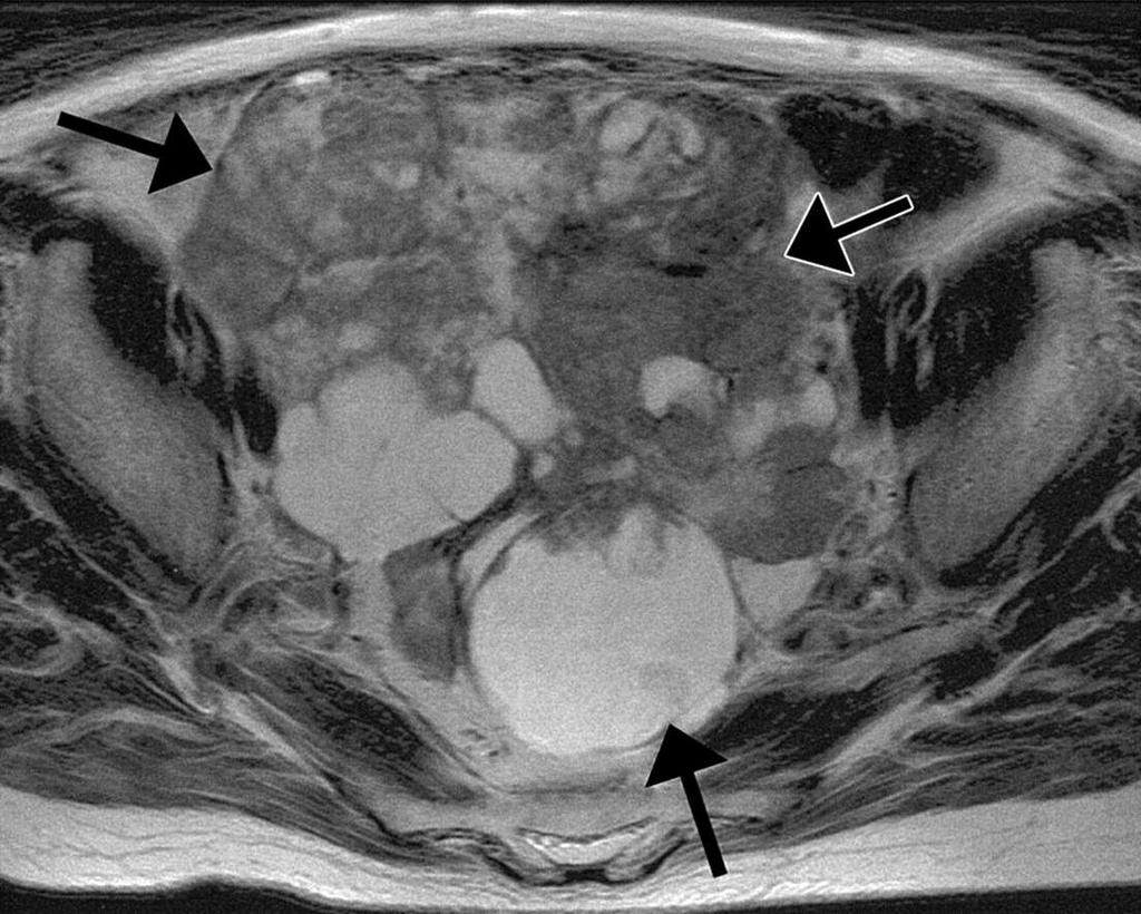Rosszindulatú daganatok: Cystadenocarcinoma (leggyakoribb) Vaskos egyenetlen fal, intracysticus növedék, 4 cm-nél nagyobb méret Hamar kialakuló peritonealis