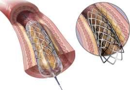 Fém stent beültetés Ballonos Ha nagy radiális erő kell: meszes laesio excentricus laesio, ostialis szűkület