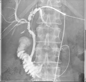 Stent beültetés kontraindikáció az életkilátás belső drainage után 3-5 nappal öntáguló fém (ballonnal